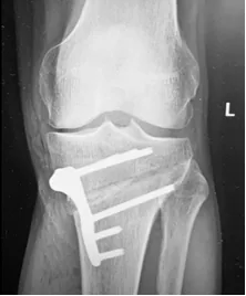 Post op imaging day 1 - 02
